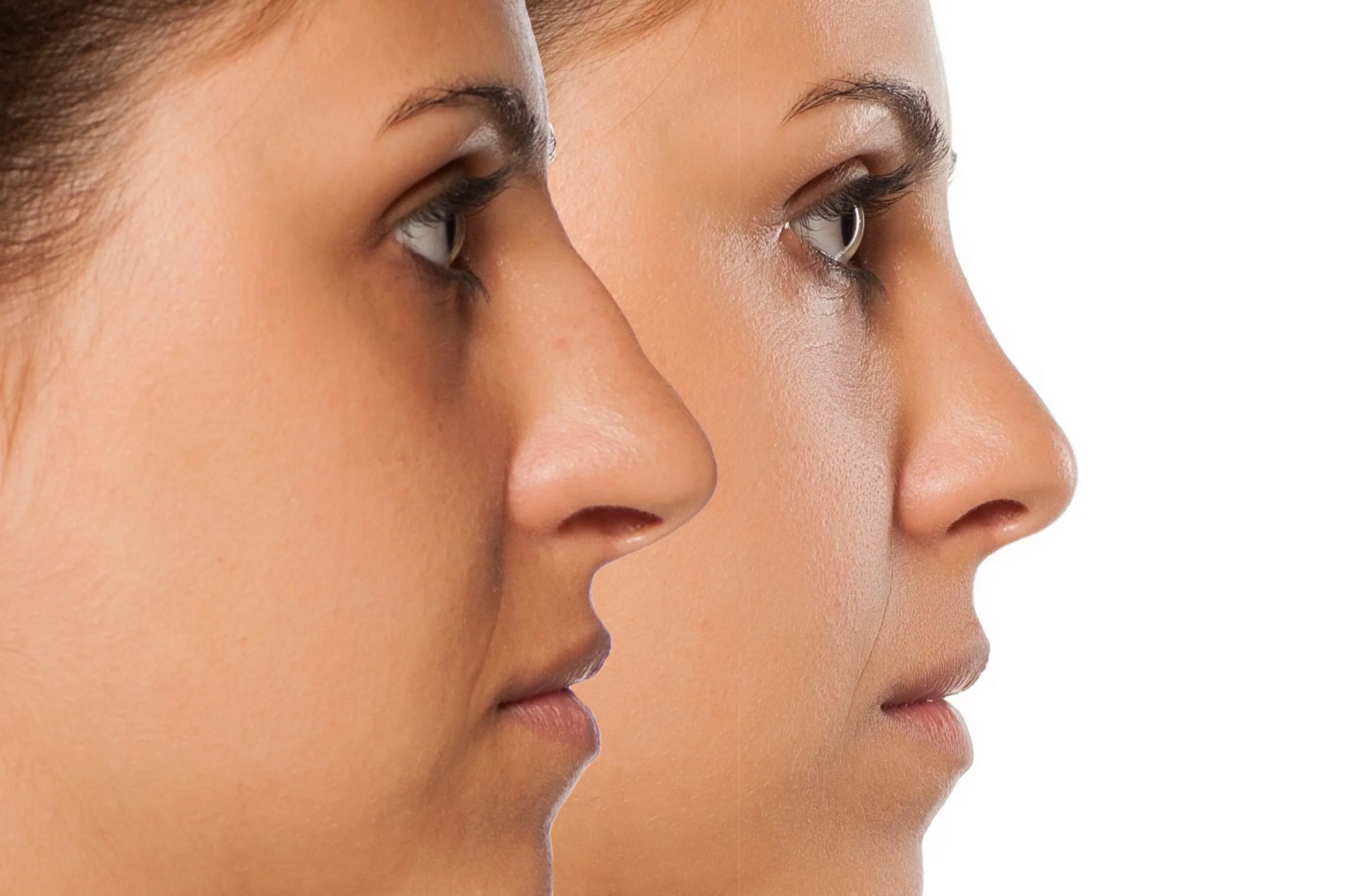 rhinoplasty surgery cost