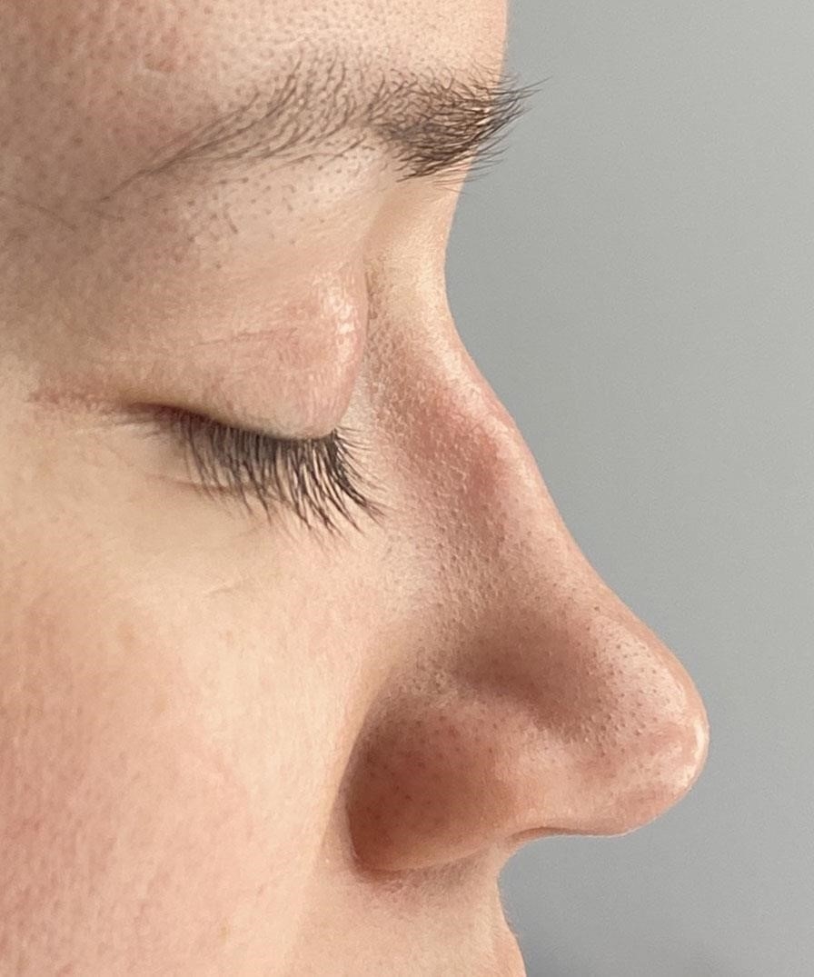 rhinoplasty expert nyc