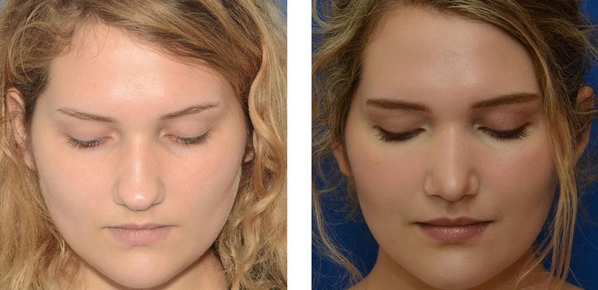 rhinoplasty surgery cost