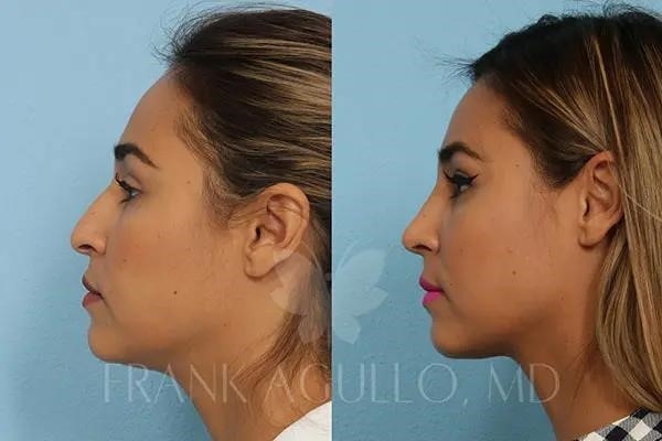 rhinoplasty expert nyc